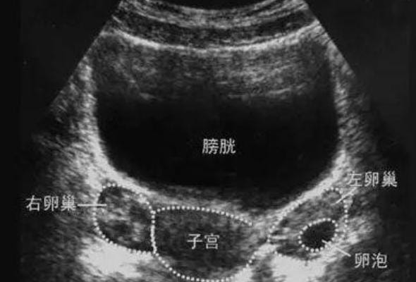 B超监测卵泡发育