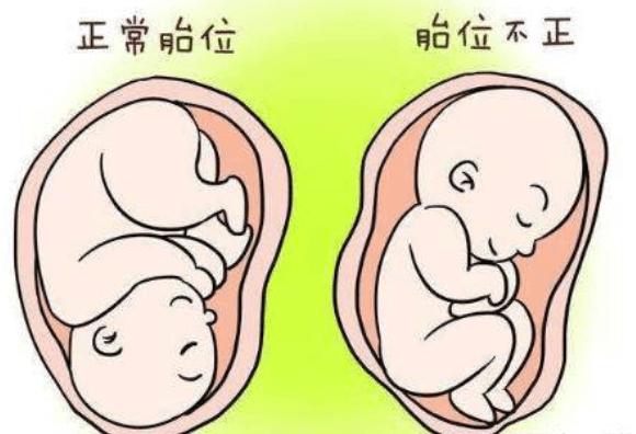 胎盘前置导致中止